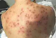 Fig 1. Fig 1. Hyperpigmented skin.