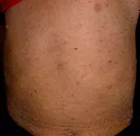 Figure 1. The rash on the patient’s trunk at presentation. Fig 1. Rash