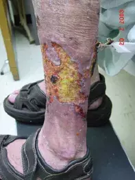 Fig 2. Pyoderma gangrenosum Fig 2. Pyoderma gangrenosum