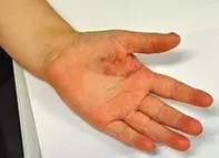 Fig 1. Palm lesion. Fig 1. Palm lesion.
