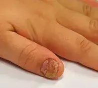 Fig 2. Dystrophic nail. Fig 2. Dystrophic nail.